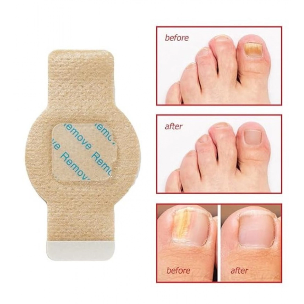 Generic Fungal Nail Patches (Yellow) - Image 4