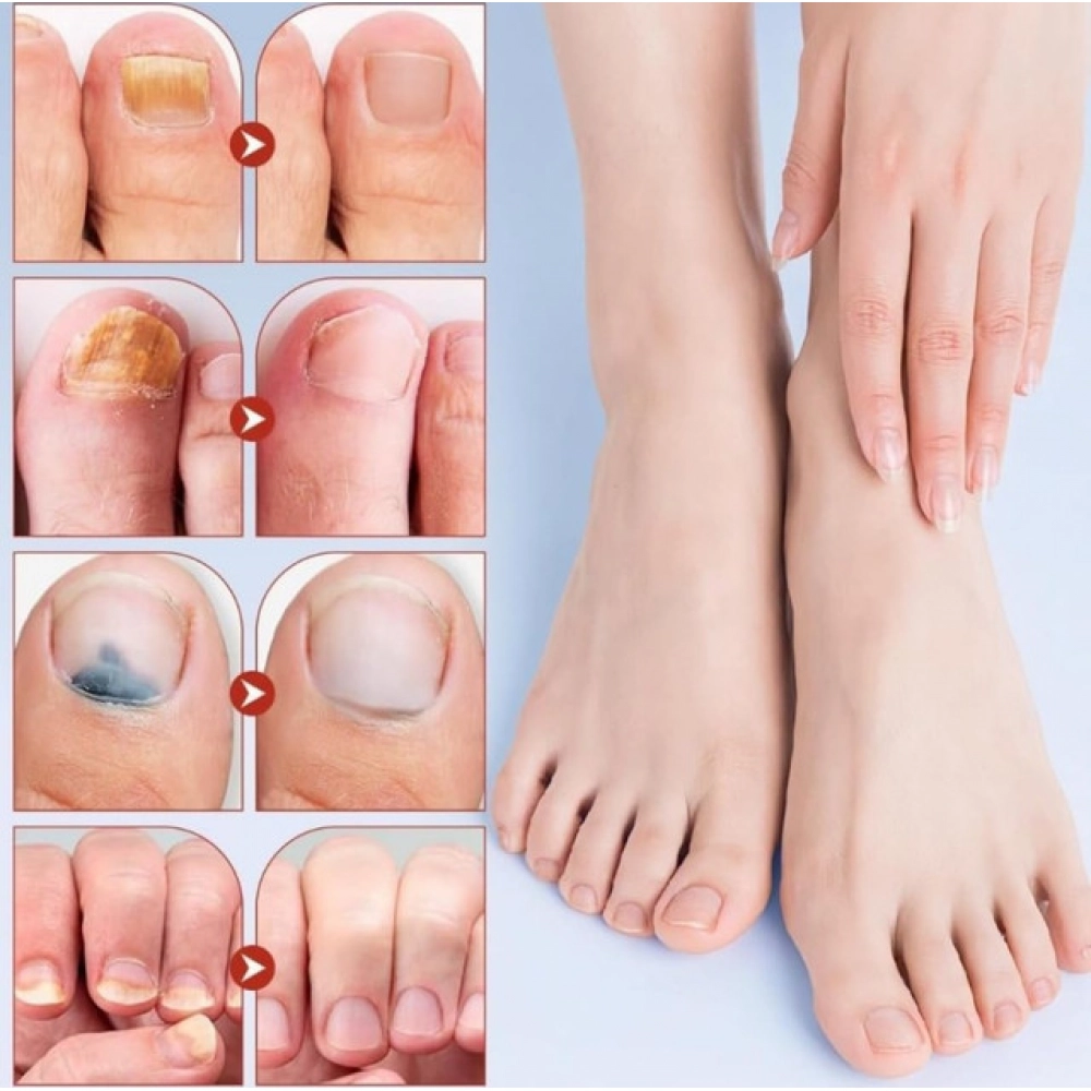 Generic Fungal Nail Patches (Yellow) - Image 3